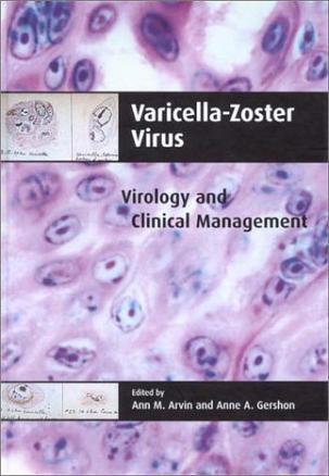 Varicella-zoster virus virology and clinical management