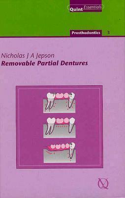 Removable partial dentures