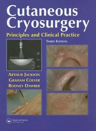 Cutaneous cryosurgery principles and clinical practice